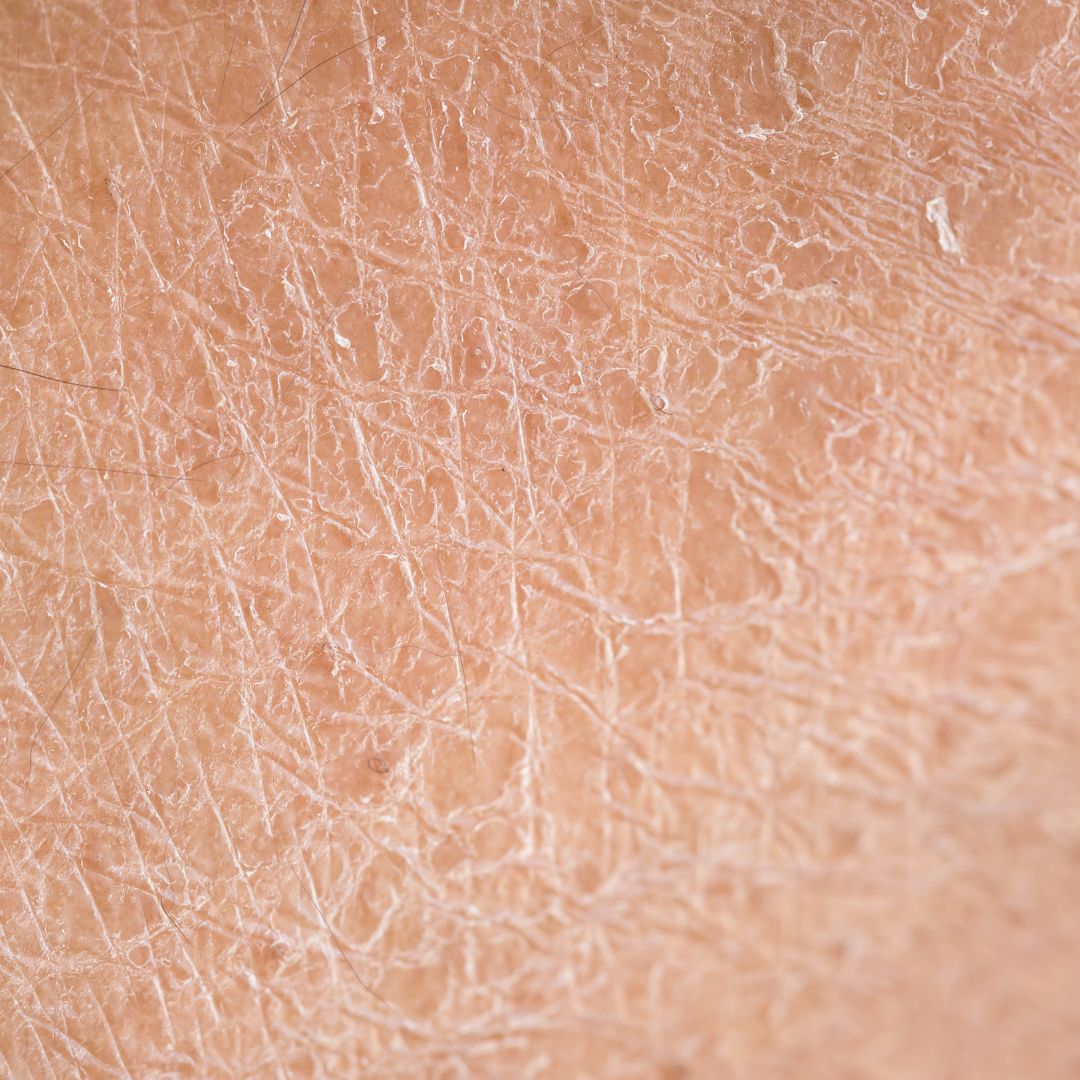 perché l'olio sulla pelle può causare secchezza | zoom su pelle secca